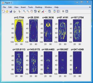 استخراج تومور از تصاویر MRI
