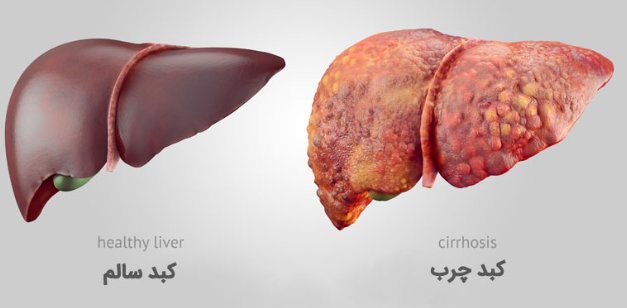 fatty liver