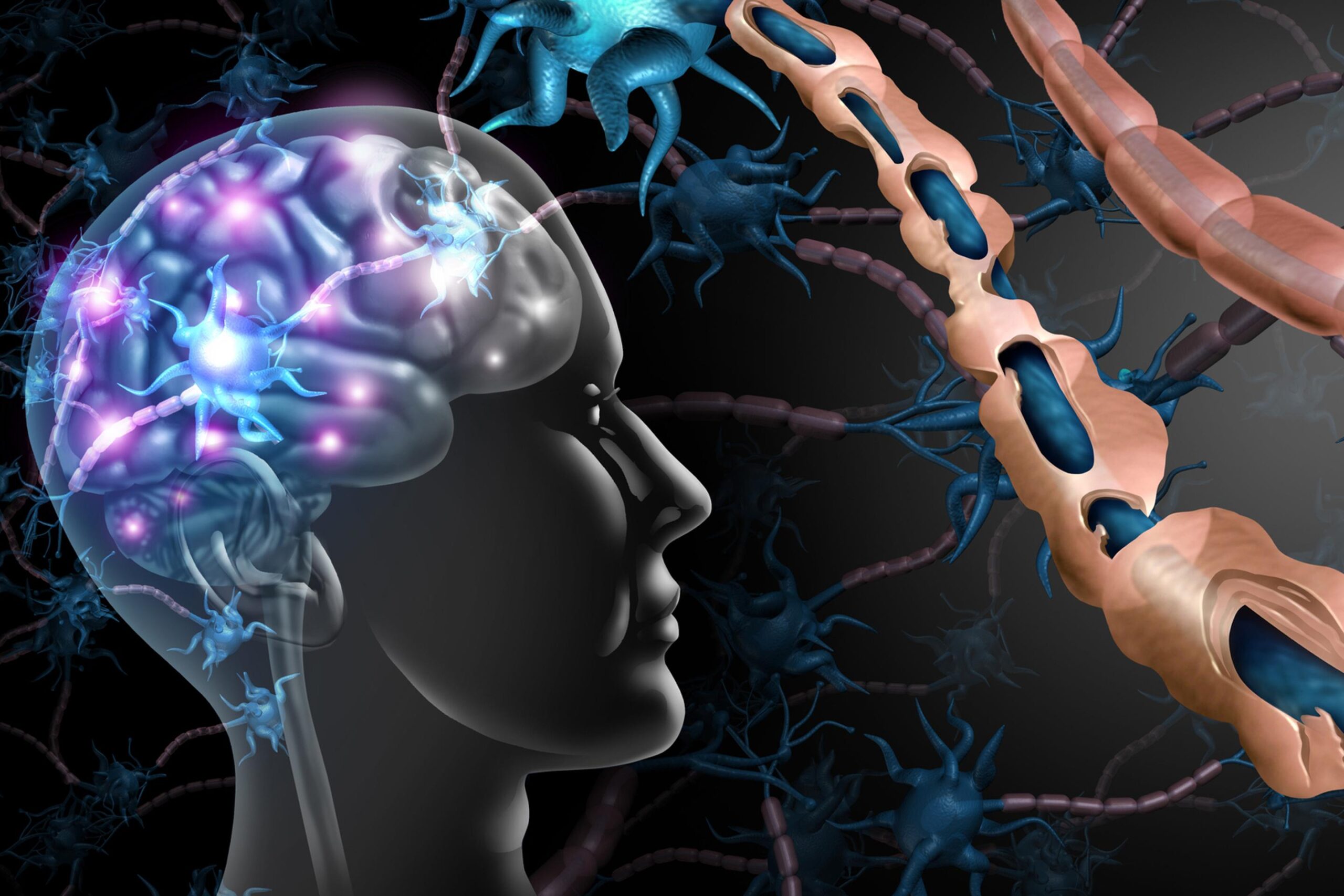 بیماری ام اس (MS)