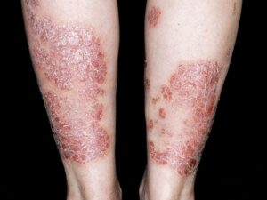 بیماری پسوریازیس (Psoriasis)