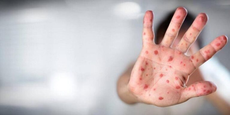 بیماری سرخک